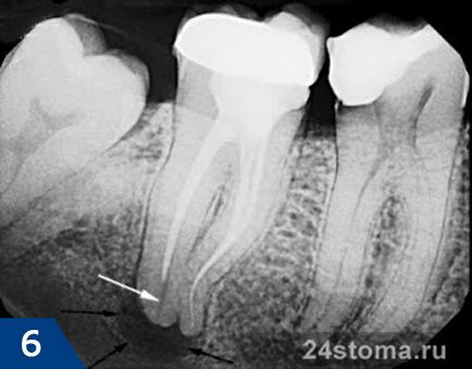 Fistula pe gingiile etape de tratament, sfaturi de specialiști