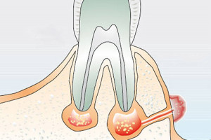 Свищ на яснах фото, причини і лікування зубного свища (дірки в роті)