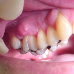 Fistula pe gingie fotografie, cauze și tratamentul fistulei (găuri în gură)