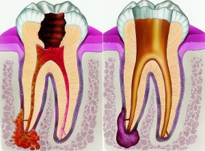 Свищ на яснах фото, причини і лікування зубного свища (дірки в роті)