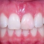 Свищ на яснах фото, причини і лікування зубного свища (дірки в роті)