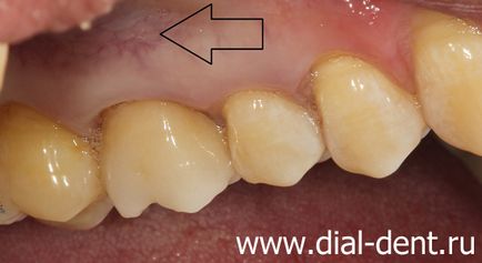 Fistula pe gingie - tratament 1