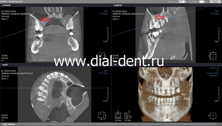 Fistula pe gingie - tratament 1