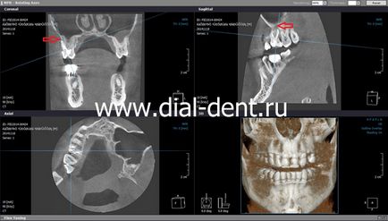 Fistula pe gingie - tratament 1