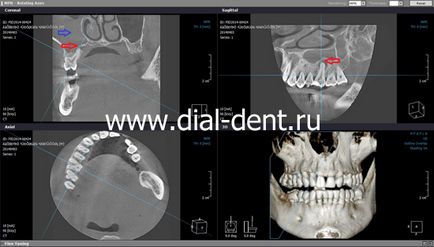 Fistula pe gingie - tratament 1