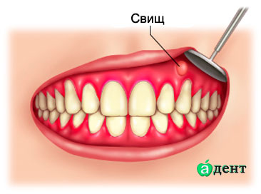 Свищ на яснах причини, симптоми, лікування