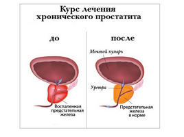 Зв'язок простатиту і імпотенції