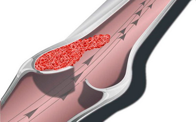 Thrombophlebitis - okoz thrombophlebitis - thrombophlebitis tünetek