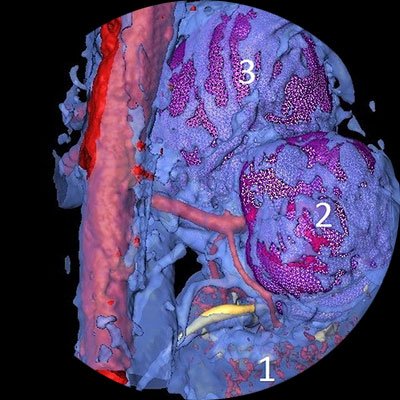 Îndepărtarea rinichiului drept cu glanda suprarenală pentru o tumoare (nefrectrelectomie)