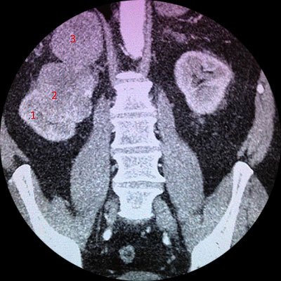 Eltávolítjuk a jobb vesét a mellékvese a tumor (nefradrenalektomiya)