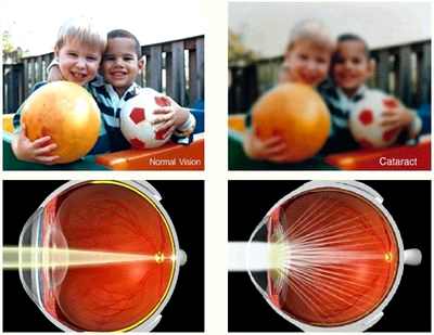 Îndepărtarea lentilei cataractei ca persoană vede o selecție a unei lentile artificiale