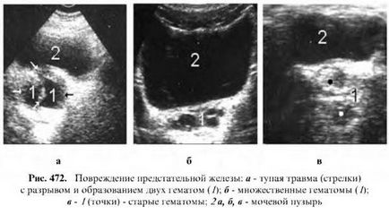 Examinarea cu ultrasunete a prostatei