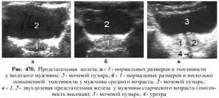 Examinarea cu ultrasunete a prostatei