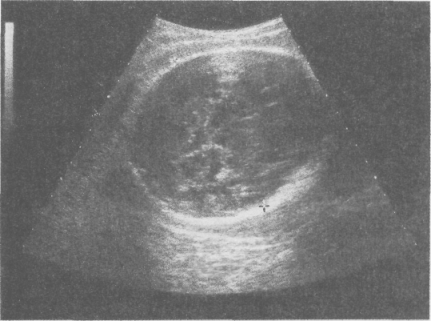 Ultrahang (ultrahang) az ultrahangos diagnosztikában alapul fordított