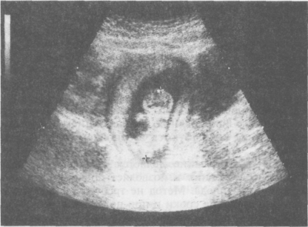 Scanarea cu ultrasunete (ultrasunete) este inversa a diagnosticului cu ultrasunete