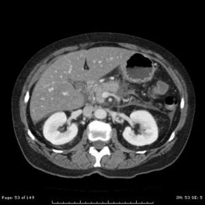 Urographin înainte de CT a cavității abdominale, metode de a lua urographine inainte de CT