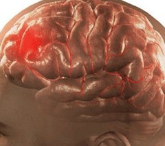 Забій головного мозку - симптоми, лікування, наслідки