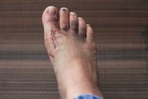 Piciorul murdar de prim ajutor și tratament