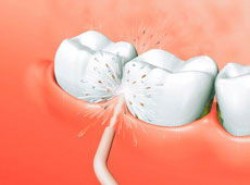 Догляд за зубними імплантами