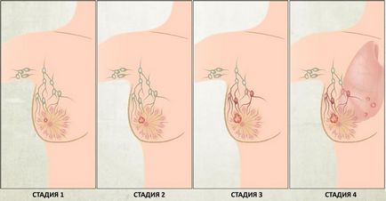 Ultrahang diagnosztika a tünetek a rák, az oka a daganatok, a készítmény, amely megmutatja, hogyan (képzés) Ultrahang diagnosztika a tünetek a rák, az oka a daganatok, a készítmény, amely megmutatja, hogyan és