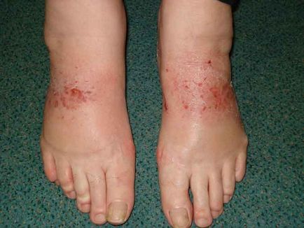 Eczemă eczemă pe picioare