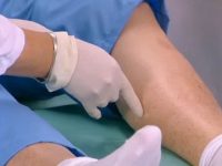 Varice ulceroase și tratamentul ulcerului trofic pe picior cu vene varicoase