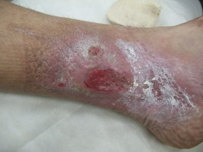 Varice ulcer cum să trateze ulcere trofice și răni pe picioare cu varice