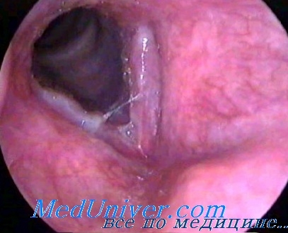 Vasculara monocondrita a laringelui