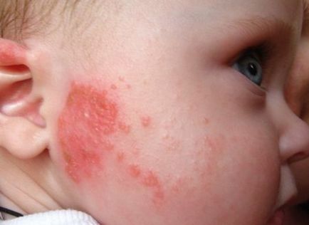 Erupțiile pe piele la copiii cu dysbioză, fotografii, simptome și tratament la sugari