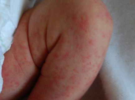 Erupțiile pe piele la copiii cu dysbioză, fotografii, simptome și tratament la sugari