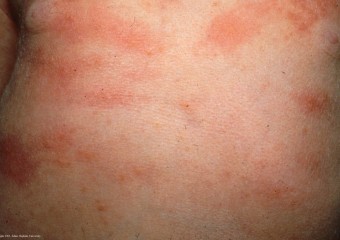 Kitörések at dysbacteriosis, bőrkiütések és foltok a bőrön, a bőr megnyilvánulások az arcon és a kezek, csalánkiütés származó