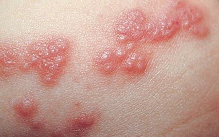 Erupțiile la o disbacterioză, o erupție și macule pe piele, expuneri dermice pe față și brațe sau pe mâini, o urticarie la