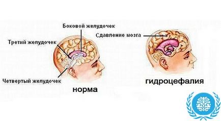 Водянка головного мозку