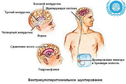 Водянка головного мозку