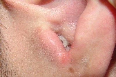 Gyulladás a külső fül okoz, a tünetek, a kezelés