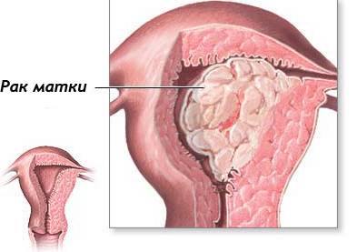 Totul despre cancerul uterin și tratamentul acestuia