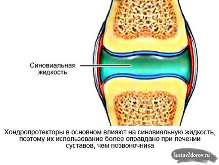 Chondroprotectori pentru osteochondroza coloanei vertebrale, eficacitate, aplicare