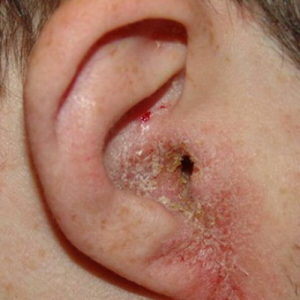 Захворювання зовнішнього вуха способи боротьби з вушними захворюваннями і їх види