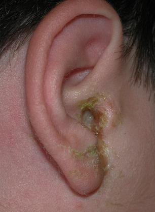 Захворювання зовнішнього вуха способи боротьби з вушними захворюваннями і їх види