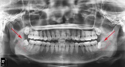 Зуб мудрості фото, де знаходиться, скільки зубів мудрості у людини може вирости, сам собі