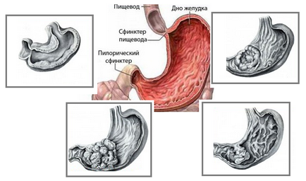 Adenocarcinomul gastric, simptome, prognostic, tratament, forme tubulare, mucinoase de cancer, stadiul 3, 4