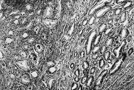 Adenocarcinomul gastric, simptome, prognostic, tratament, forme tubulare, mucinoase de cancer, stadiul 3, 4