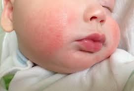 Алергія у новонароджених дітей симптоми, причини, лікування, профілактика, ускладнення