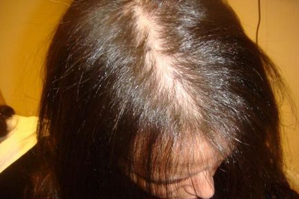 Alopecia la femei și tratament