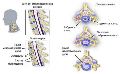 Applikátor Kuznetsova a osteochondrosis a nyaki gerinc