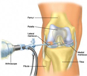 Artroscopia articulației genunchiului și operativ