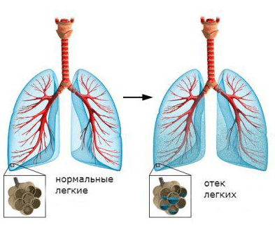 Forme atipice ale infarctului miocardic, simptome