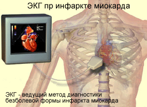 Forme atipice ale infarctului miocardic, simptome