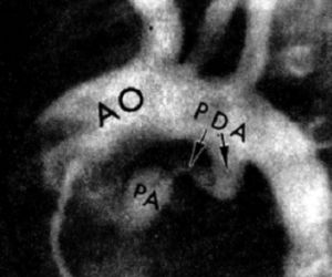 Atrezia supapei arterei pulmonare cu sept interventricular intact - cardiolog - site despre