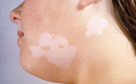 Білі плями на шкірі після засмаги